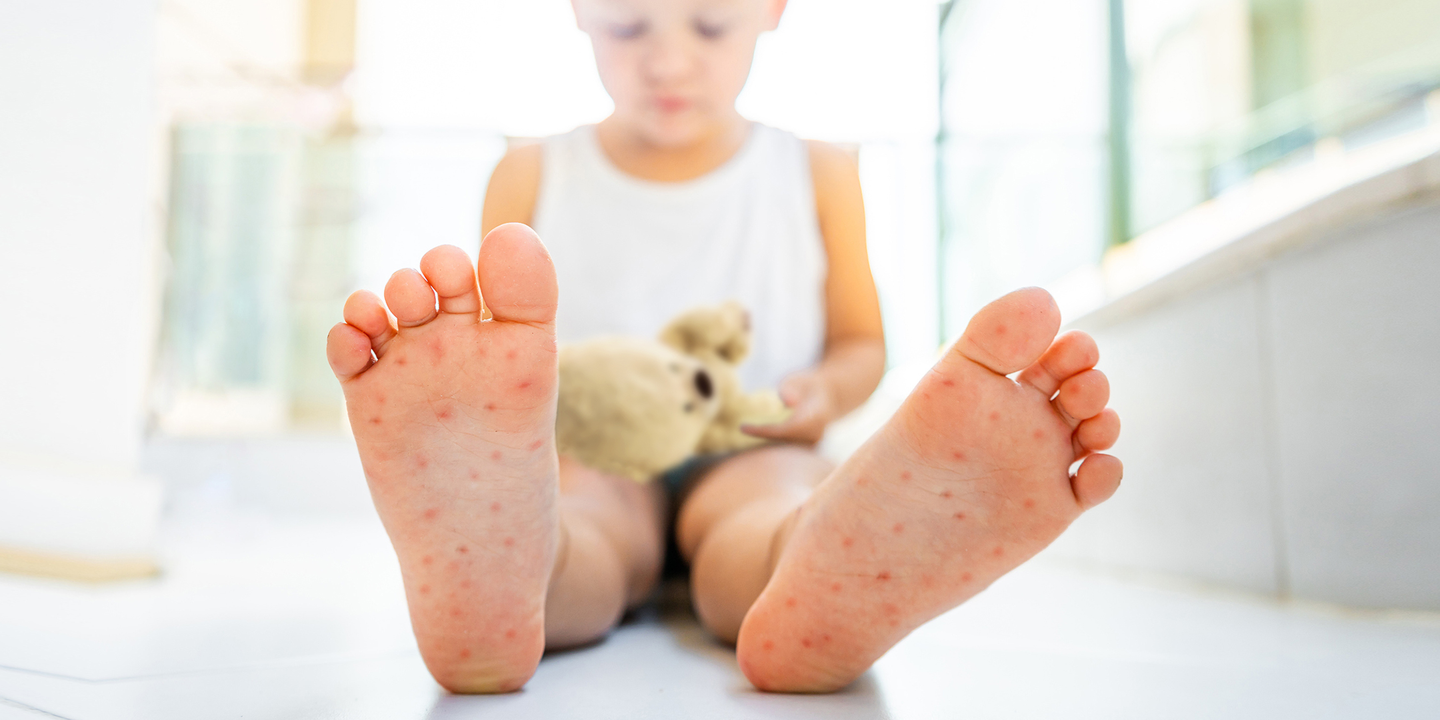 Foto: Ein kleiner Junge sitzt auf dem Boden, im Fokus des Bildes sind seine Fußsohlen mit roten Flecken.