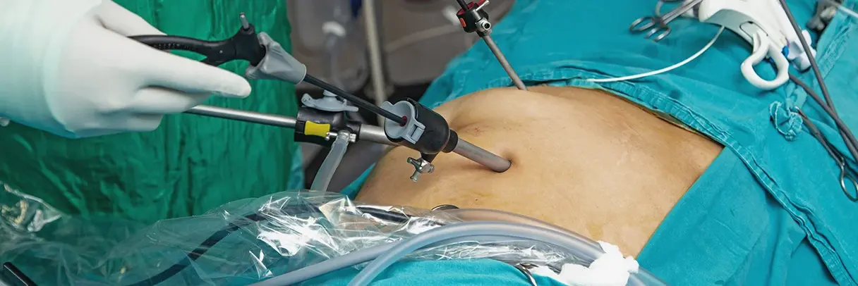 Das Bild zeigt eine Operation im Bauchraum, konkret eine laparoskopische Magenkrebs-OP. 