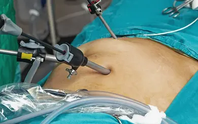 Das Bild zeigt eine Operation im Bauchraum, konkret eine laparoskopische Magenkrebs-OP. 