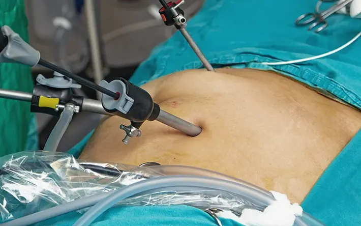 Das Bild zeigt eine Operation im Bauchraum, konkret eine laparoskopische Magenkrebs-OP. 