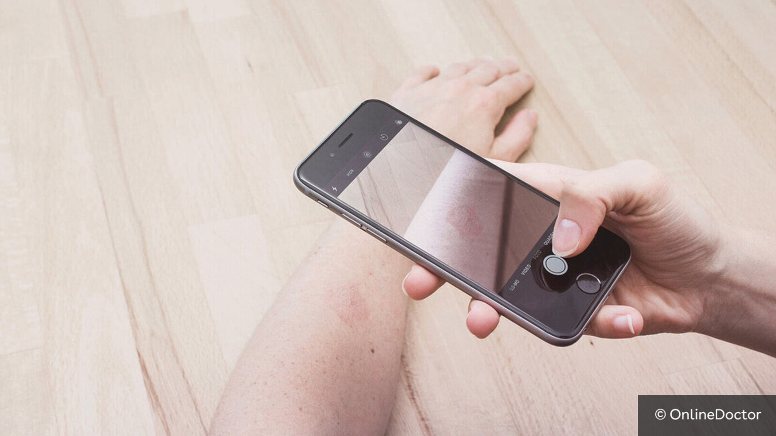 Eine Mann hält ein Handy in der rechten Hand und fotografiert mit der Kamera seinen linken Arm, der auf einer Holztischplatte ruht und auf dem ein roter Ausschlag zu erkennen ist.