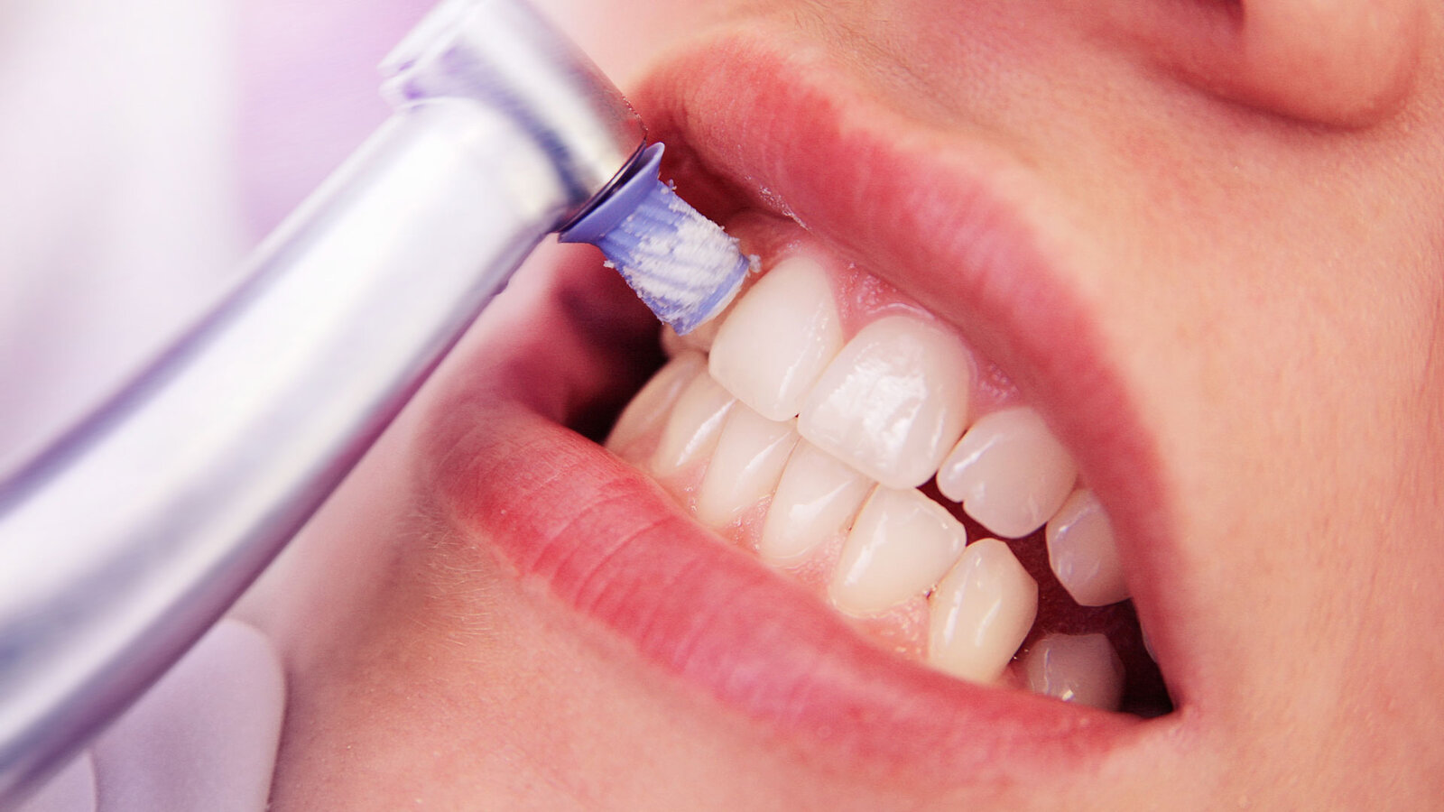 Professionelle Zahnreinigung – Zähne einer Frau werden poliert ©adobestock/picdog 