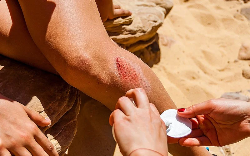 Das Bild zeigt ein unbekleidetes Bein mit einer oberflächlichen Schürfwunde. Eine andere Person, von der nur die Hände zu sehen sind, trägt eine Lösung aus einem Fläschchen auf.