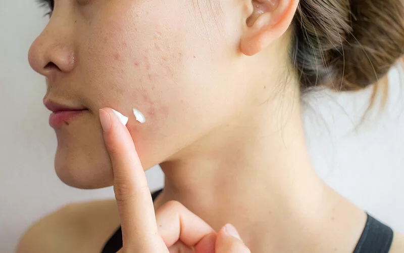 Eine Frau behandelt ihre Akne mit einer speziellen Salbe.