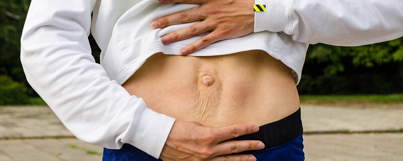 Der Bauch einer Frau mit Rektusdiastase nach der Schwangerschaft.