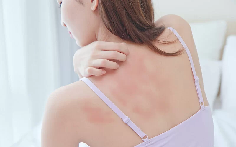 Eine junge Frau mit Nesselsucht kratzt sich am Rücken.