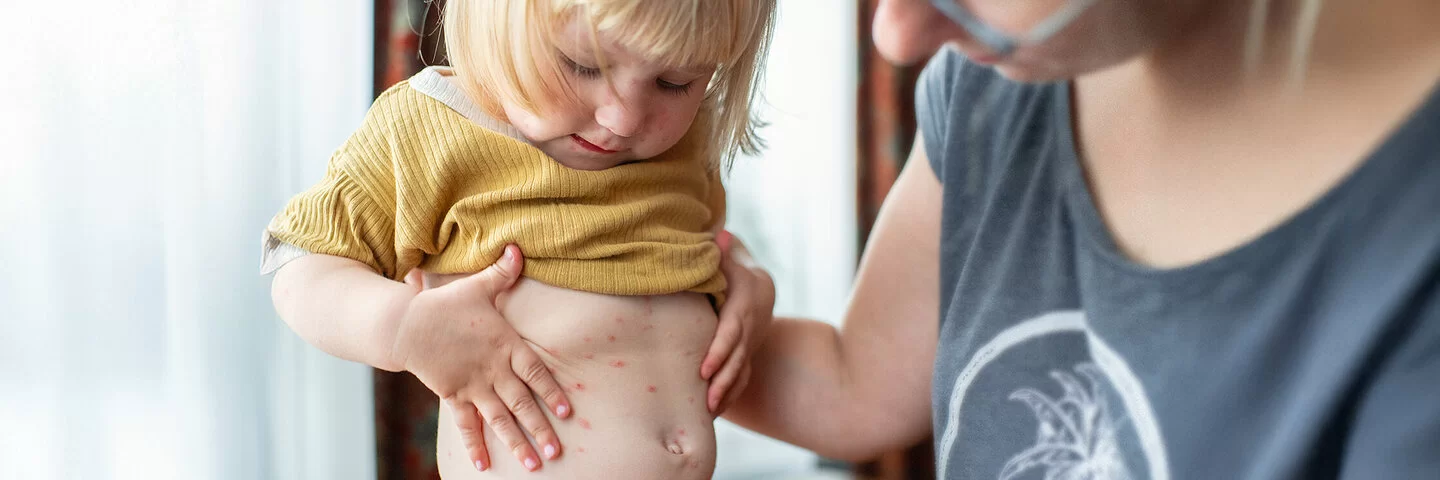Ein kleines blondes Mädchen mit gelbem T-Shirt und roter Hose hat viele Windpocken-Bläschen auf Bauch und Brust, die Mutter (nur im Anschnitt zu sehen) hält das Kind fest.