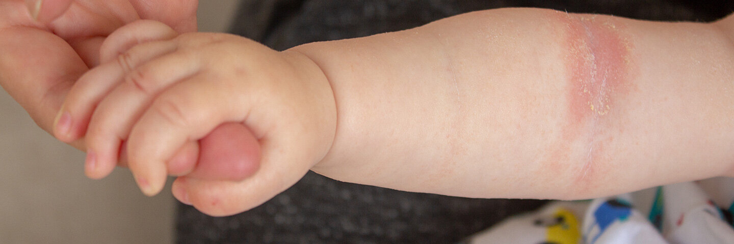 Nahaufnahme der Handfalten eines Neugeborenen mit Neurodermitis.