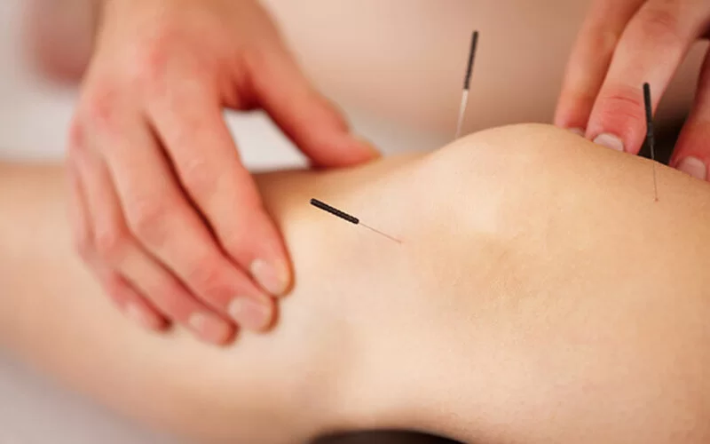 Patientin bekommt eine Akupunktur am Knie.