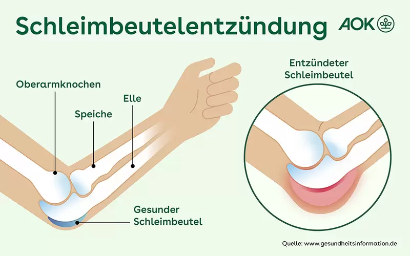 Schematische Darstellung von Ober- und Unterramknochen mit gesundem und entzündeten Schleimbeutel.