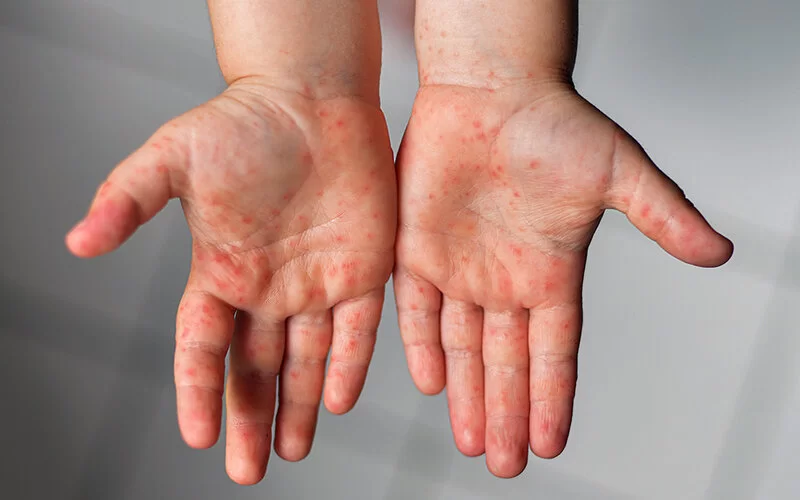 Ein nicht-juckender Ausschlag bildet sich auf den Händen bei der Hand-Fuß-Mund-Krankheit.