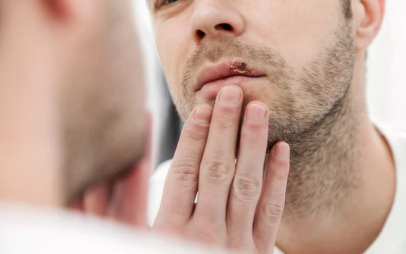 Ein Mann mit Lippenherpes betrachtet sich im Spiegel.