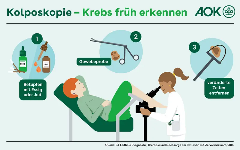 Die Grafik zeigt eine junge Frau auf einem gynäkologischen Stuhl. Eine Ärztin untersucht sie mit einem Kolposkop. Gezeigt werden auch die einzelnen Schritte einer Kolposkopie.