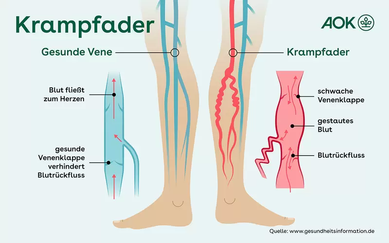 Illustration von zwei Beinen, links mit gesunder Vene, rechts mit Krampfader.