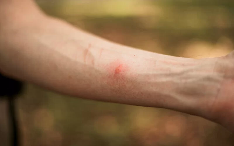 Jemand leidet an Insektengiftallergie und zeigt den zerstochenen Unterarm her.