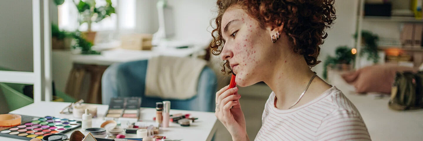 Eine junge Frau behandelt ihre Akne im Gesicht mit einem speziellen Akne-Stift.