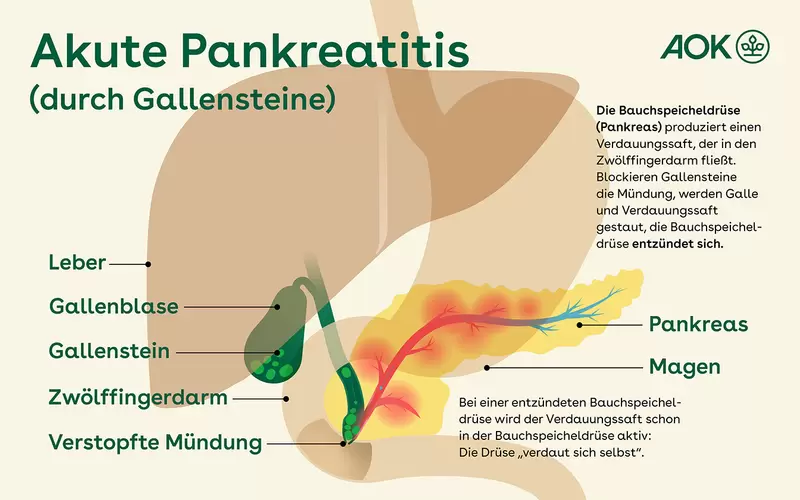 Im Schaubild werden die Verdauungsorgane sowie Gallensteine als Ursache einer akuten Pankreatitis gezeigt.