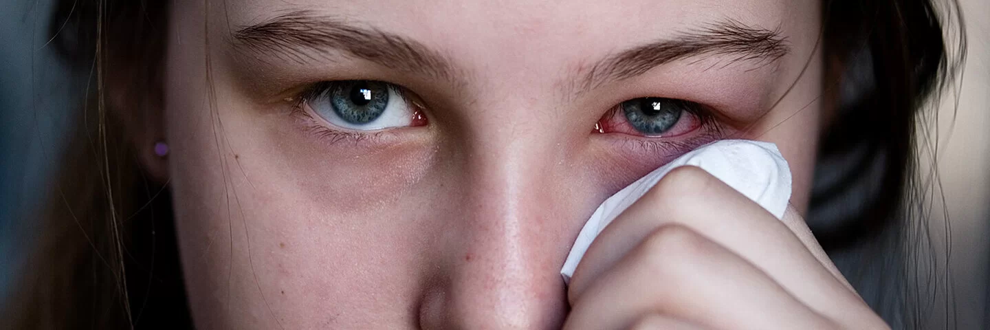 Das Auge eines Mädchens ist aufgrund einer Bindehautentzündung gerötet.