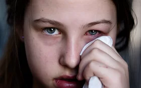 Das Auge eines Mädchens ist aufgrund einer Bindehautentz�ündung gerötet.