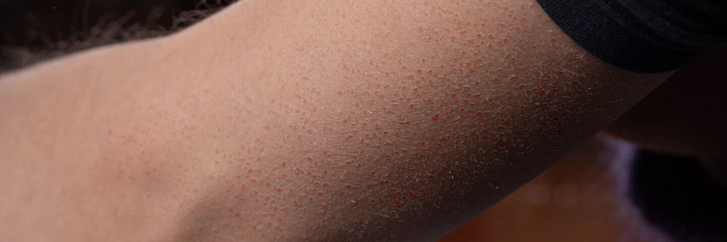 Keratosis pilaris am Oberarm.