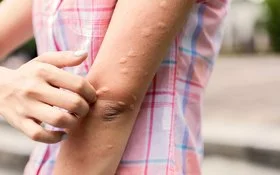 Frau juckt sich, weil sie Mückenstiche hat.