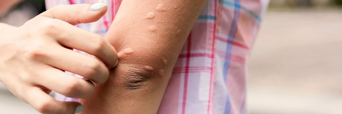 Frau juckt sich, weil sie Mückenstiche hat.