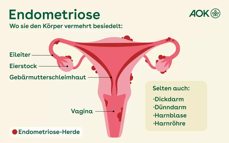 Schaubild möglicher Endometriose-Herde im weiblichen Körper.
