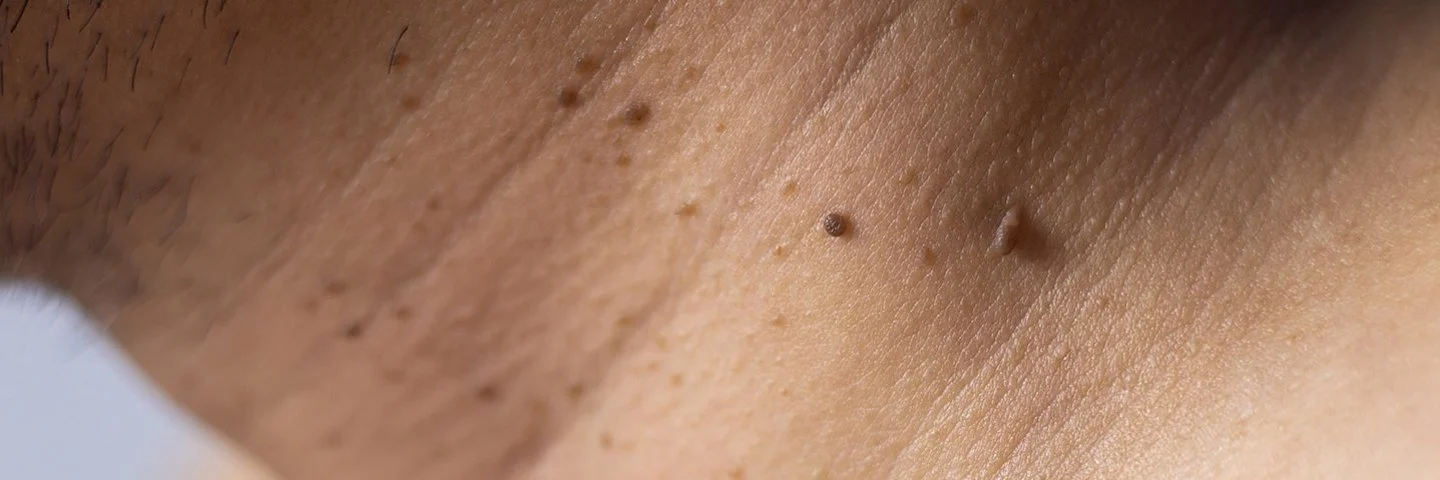 Eine Nahaufnahme vom Hals mit weichen Fibromen.