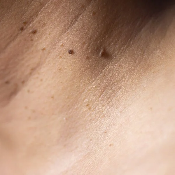 Eine Nahaufnahme vom Hals mit weichen Fibromen.