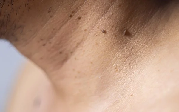 Eine Nahaufnahme vom Hals mit weichen Fibromen.