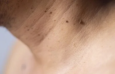 Eine Nahaufnahme vom Hals mit weichen Fibromen.