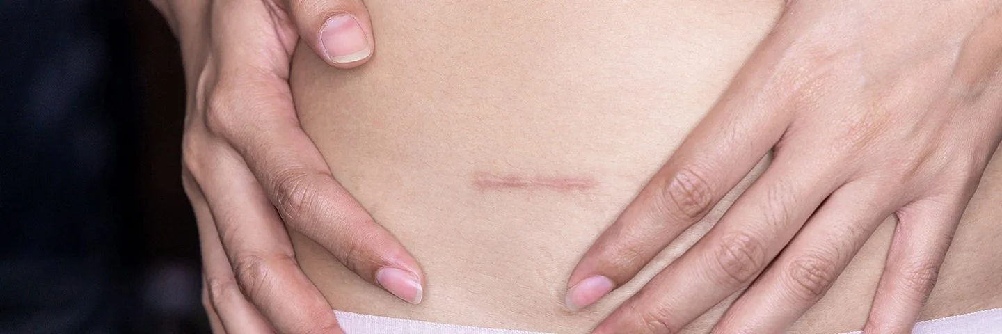 Es ist eine Narbe auf dem Unterbauch einer Person zu sehen, die beide Hände auf ihren Bauch legt.
