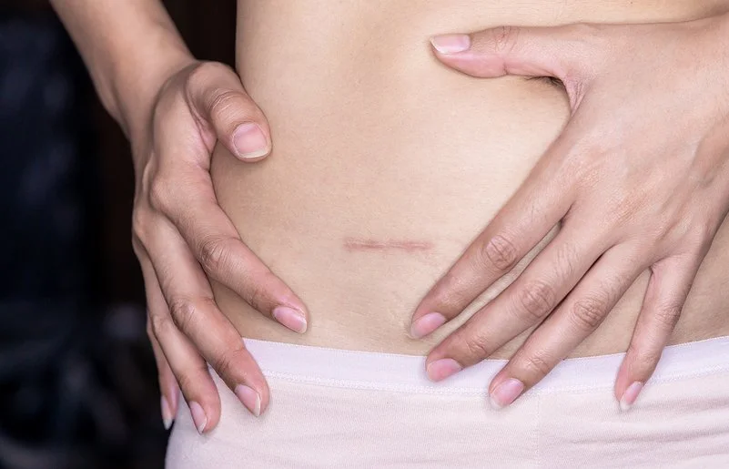 Es ist eine Narbe auf dem Unterbauch einer Person zu sehen, die beide Hände auf ihren Bauch legt.