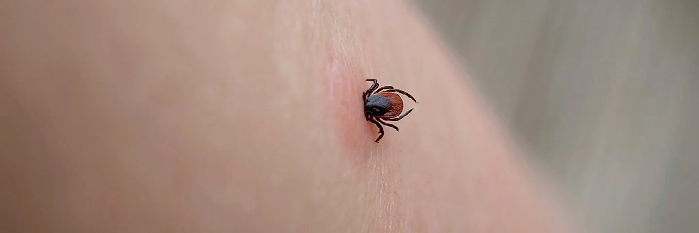 Nahaufnahme einer saugenden Zecke auf menschlicher gereizter Haut.