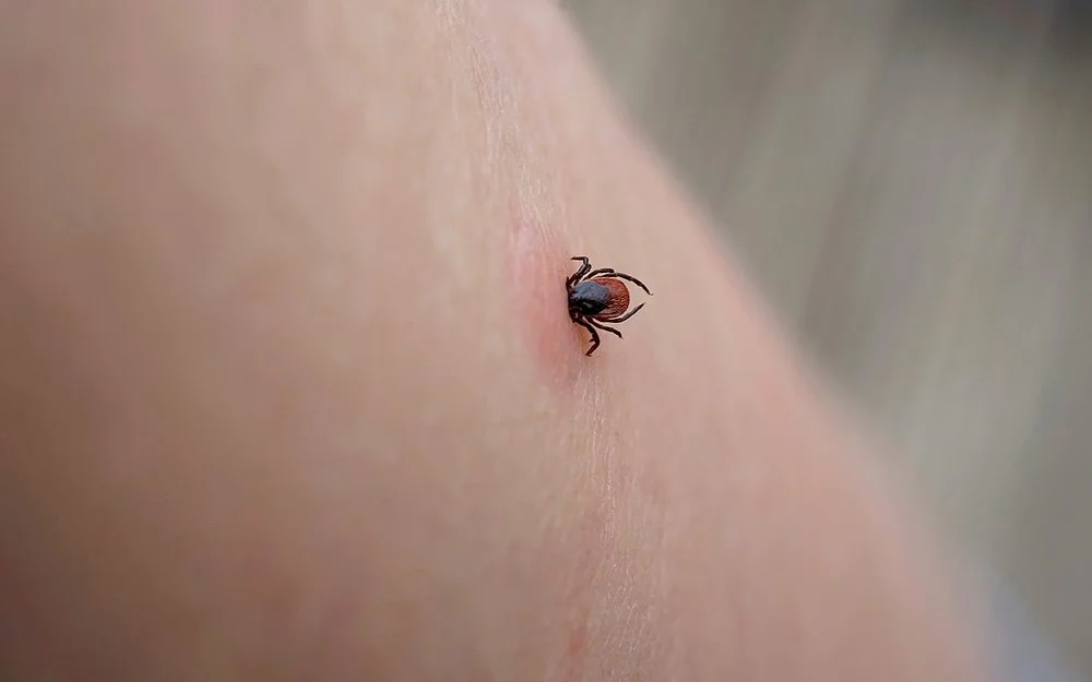 Nahaufnahme einer saugenden Zecke auf menschlicher gereizter Haut.
