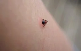 Nahaufnahme einer saugenden Zecke auf menschlicher gereizter Haut.