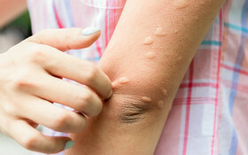 Wie man Schwellungen nach einem Bienenstich reduzieren kann