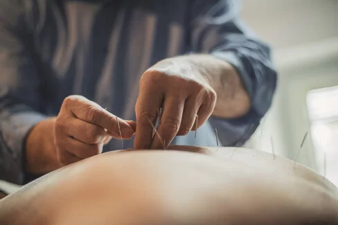 Ein Therapeut setzt Nadeln am Rücken eines Patienten. Bei einigen Erkrankungen kann Akupunktur als Ergänzung zur wissenschaftsorientierten Medizin eingesetzt werden.