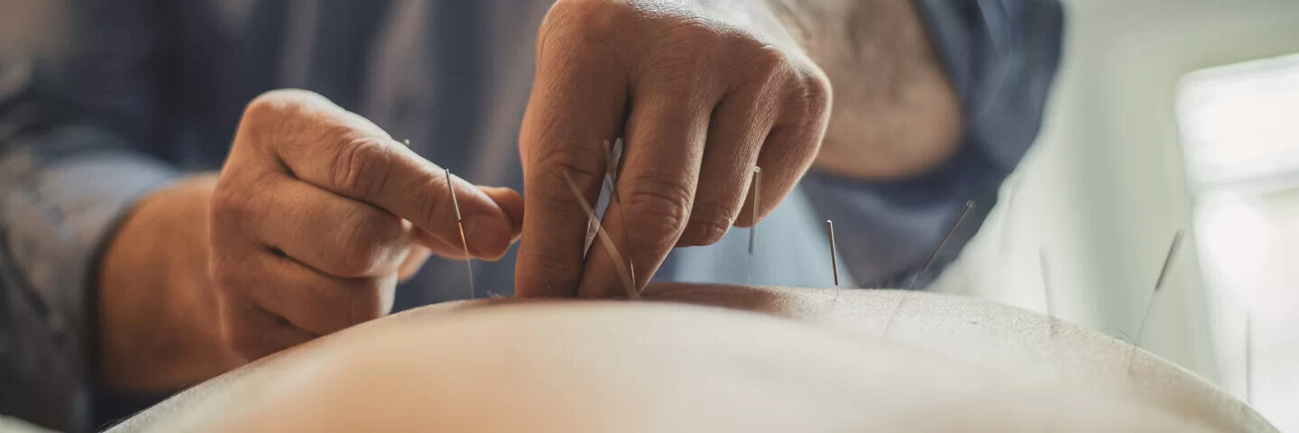Ein Therapeut setzt Nadeln am Rücken eines Patienten. Bei einigen Erkrankungen kann Akupunktur als Ergänzung zur wissenschaftsorientierten Medizin eingesetzt werden.