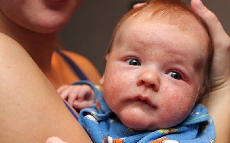 Baby Allergie vorbeugen mit diesen Tipps