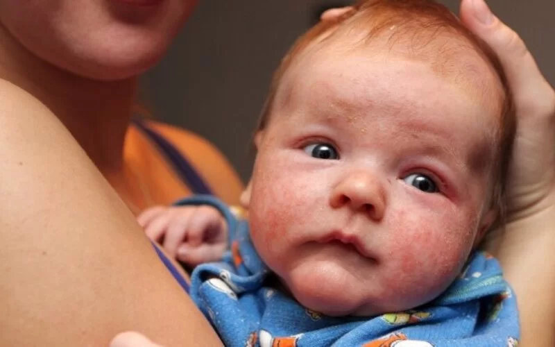 Ein Baby auf dem Arm seiner Mutter leidet an einer Allergie.