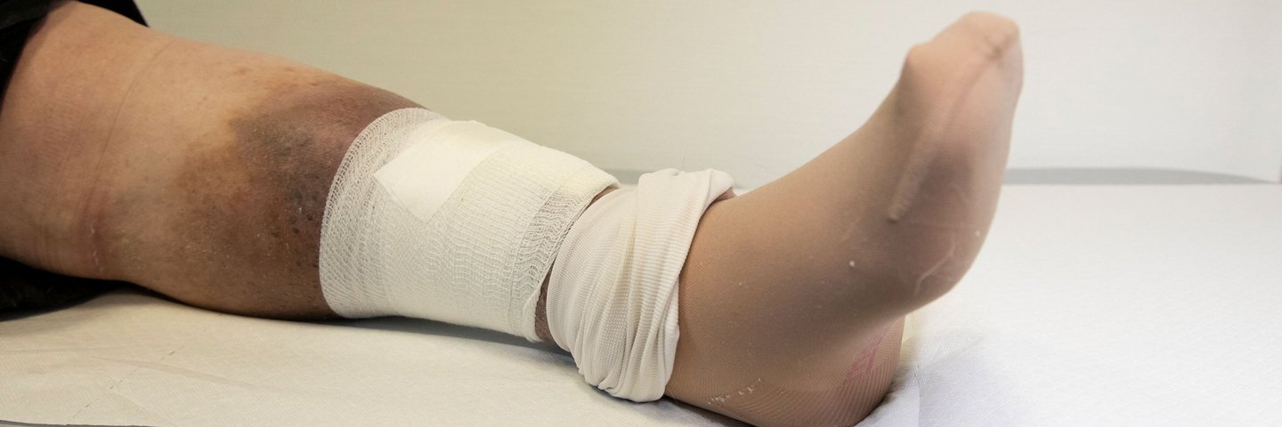 Auf dem Foto ist in Bein auf einer Liege zu sehen, das entzündet ist und teilweise verbunden ist.