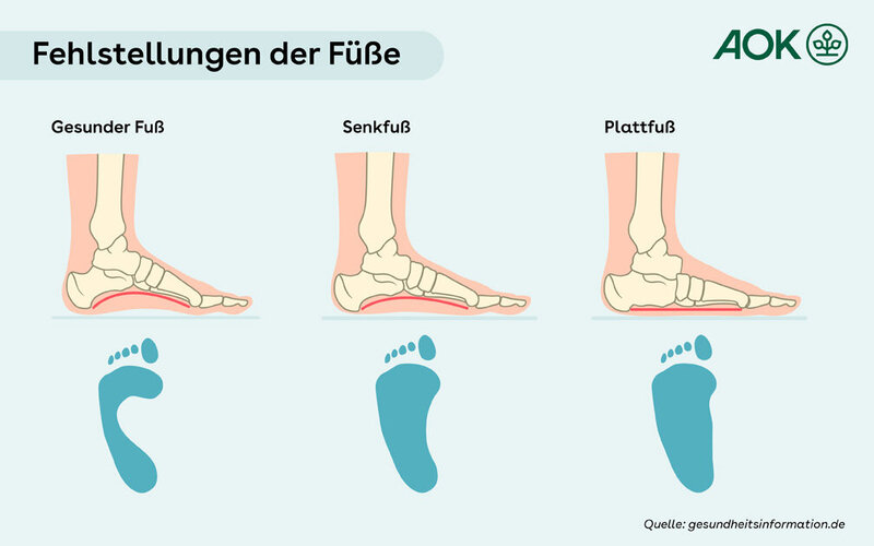 Senkfuß und Plattfuß: Ursachen, Symptome und Behandlung