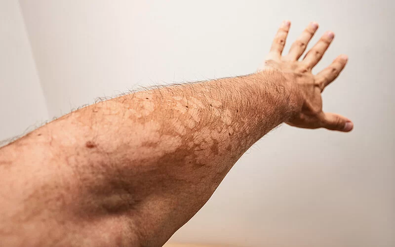 Ein nackter Arm mit Kleienpilzflechte (Pityriasis versicolor).