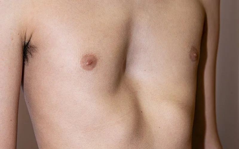 Zu sehen ist der nackte Oberkörper eines Teenagers. Seine Brustwand ist deformiert und eingefallen.
