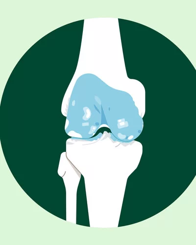 Die Illustration zeigt ein Kniegelenk mit Knorpelschäden.