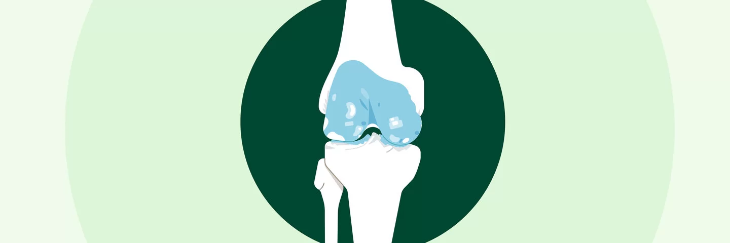 Die Illustration zeigt ein Kniegelenk mit Knorpelschäden.