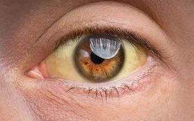 Das Auge eines Gelbsucht-Patienten, das Augenweiß ist typisch gelblich verfärbt.