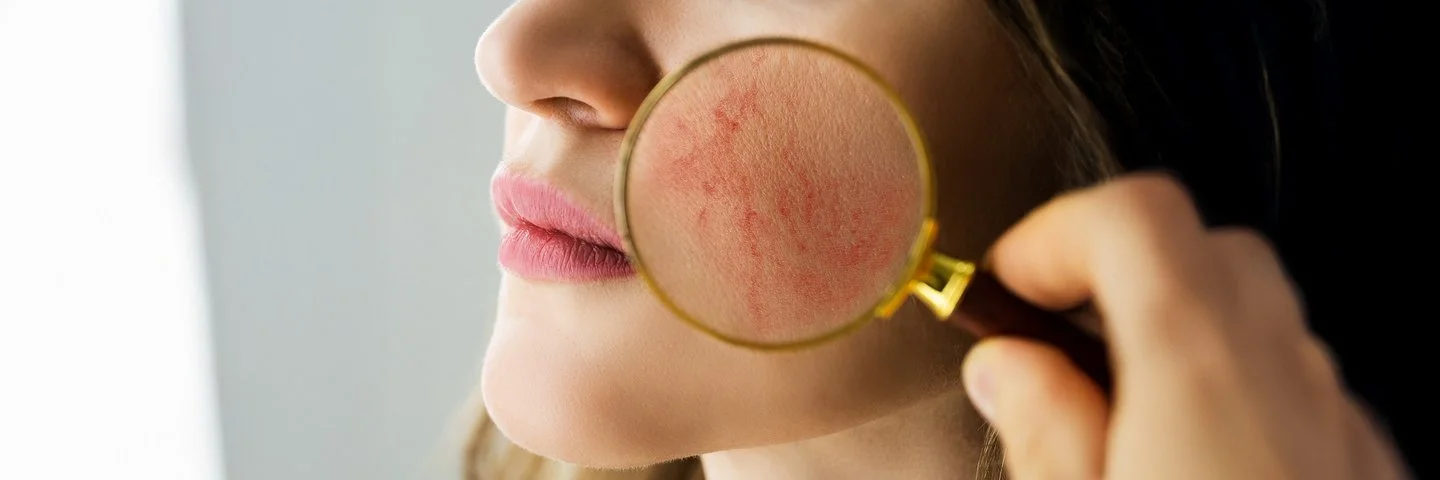 Eine Lupe wird auf die Wange einer jungen Frau gehalten. Durch das Vergrößerungsglas zeigen sich auf ihrer Haut rote Äderchen.