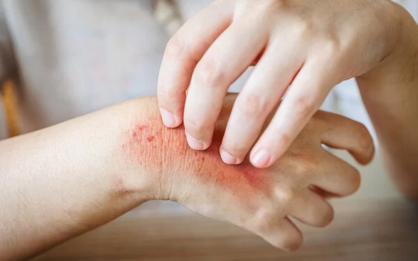 Eine nicht sichtbare Person kratzt sich an der Hand.